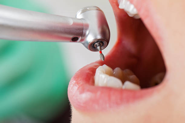 Best Emergency Dental Care for Broken or Chipped Teeth in Bluff City, TN